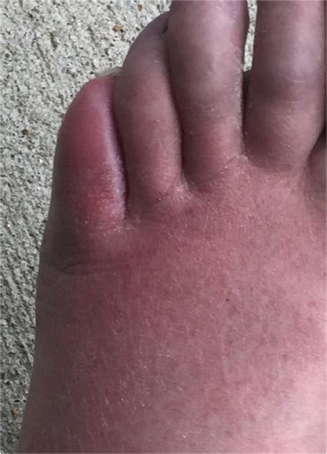 A Red Painful And Swollen Foot Overlying A Bone Erosion The American Journal Of Medicine
