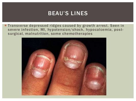 Leukonychia Vs Terry S Nails Nail Ftempo