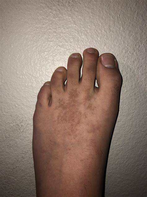 What Causes A Rash On My Feet