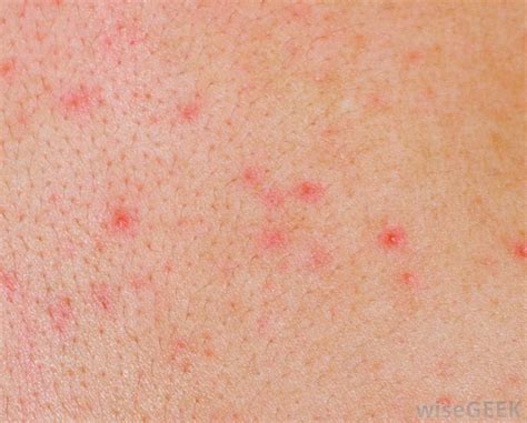 Red Itchy Rashes On Skin How To Choose And Use The Best Moisturizer