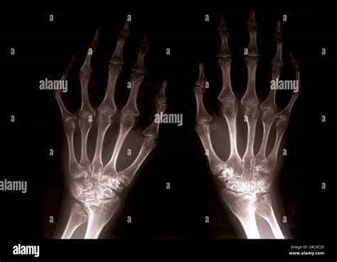 X Ray Hands Arthritis Hi Res Stock Photography And Images Alamy