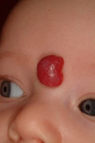 👉 strawberry hemangioma pictures symptoms causes treatment december 2021