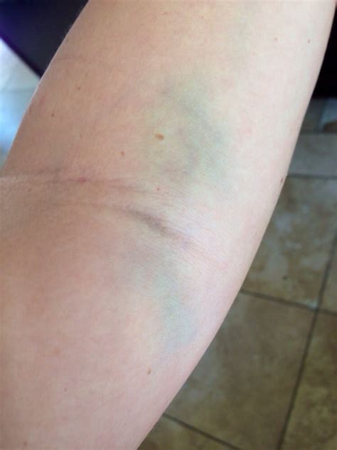 Still Have This Bruise On My Arm After Getting Blood Drawn Two Weeks