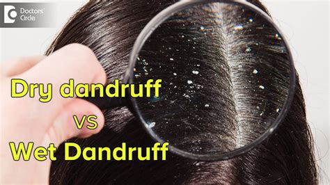 Dry Dandruff Vs Wet Dandruff How To Recognize And Treat Them Dr