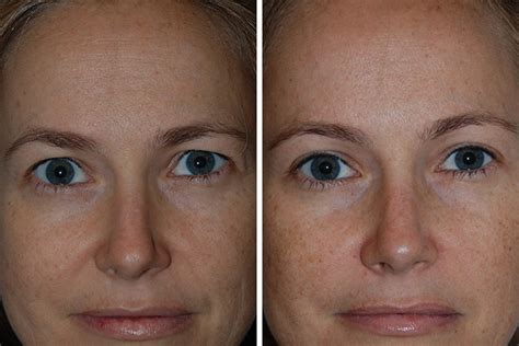 Endoscopic Brow Lift Eyelid Surgery Eye Lift For Women In New York