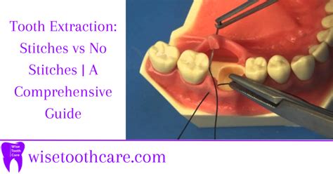 Tooth Extraction Stitches Vs No Stitches A Comprehensive Guide