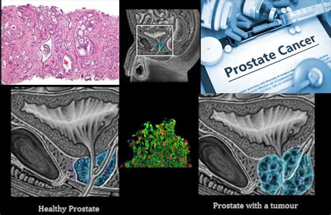 The Development Of Effective Anti Androgen Therapies For Prostate Cancer Is A Major Scientific