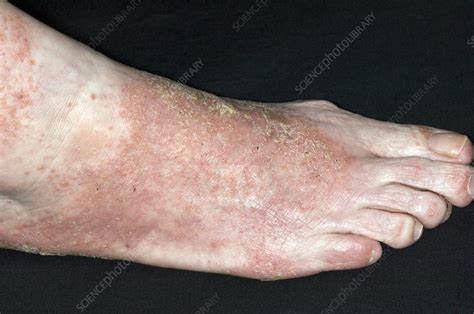 Infected Eczema On The Foot Stock Image C0083606 Science Photo