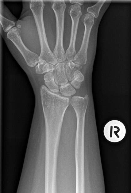Normal Wrist X Rays Radiology Case