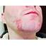 I’ve Had This Rash For About 6 Months On Both Sides Of My Chin The 