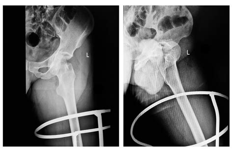 Cureus An Unusual Presentation Of Pubic Type Anterior Hip Dislocation With Concomitant