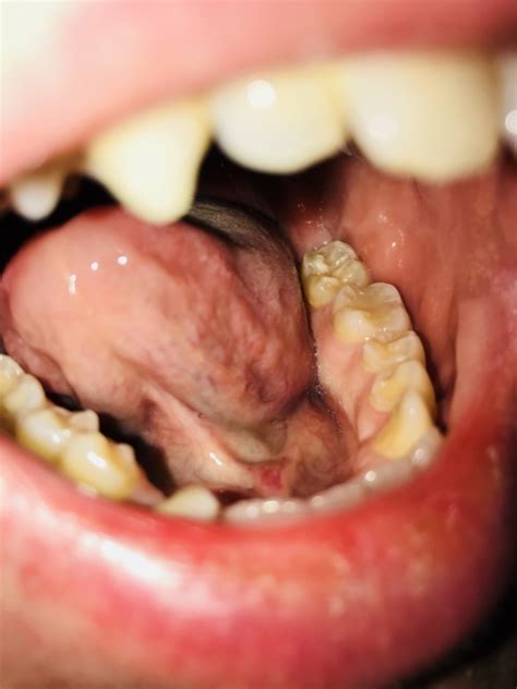 White Spots On Gums Yellow Tongue And Mouth Discomfort Oral And