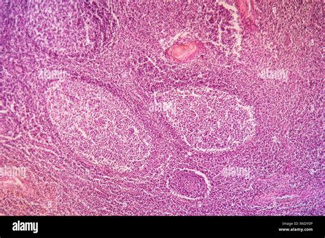 Tonsillitis Diseased Tissue 100x Stock Photo Alamy