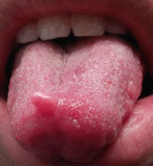 Taste buds are sensory organs that are found on your tongue and allow you to experience tastes that are sweet, salty, sour, and bitter. Swollen Taste Buds (Inflamed), On Back of Tongue, Sides ...
