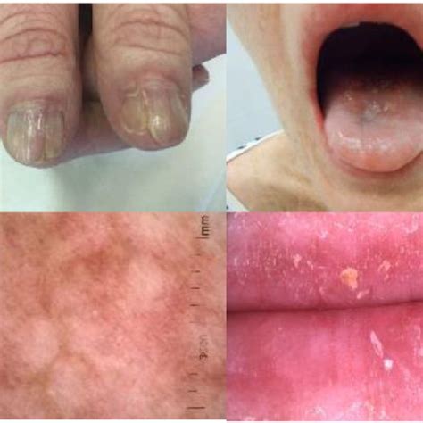 Chronic Graft Vs Host Disease Manifestations In Patient Involving Skin