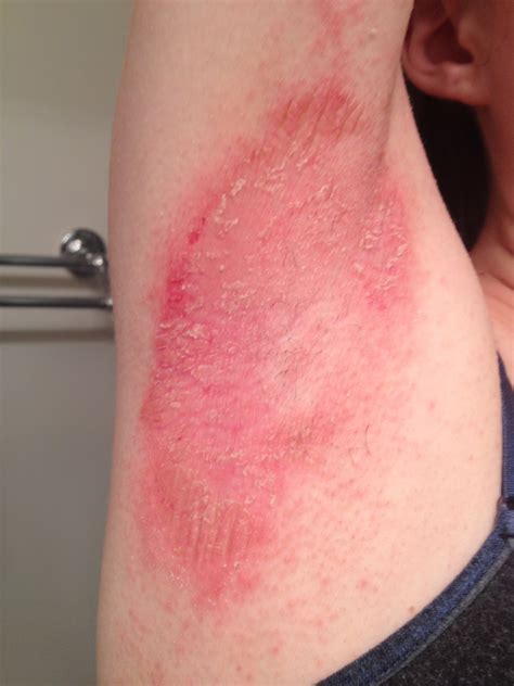 Eczema Skin Rashes On Arms Images And Photos Finder