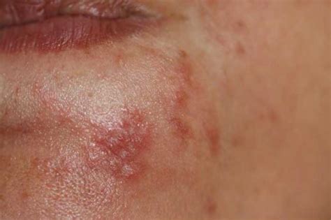 Diseases Of The Sebaceous Glands Perioral Dermatitis Picture