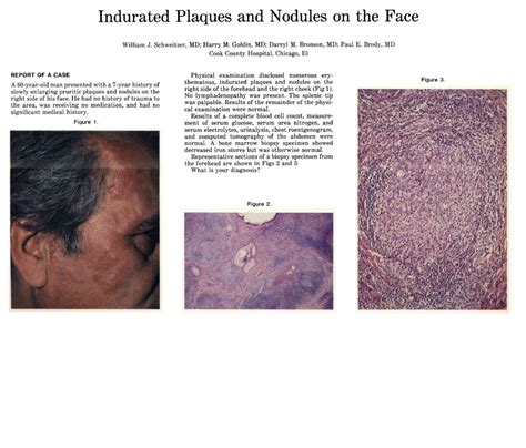 Indurated Plaques And Nodules On The Face Jama Dermatology Jama Network