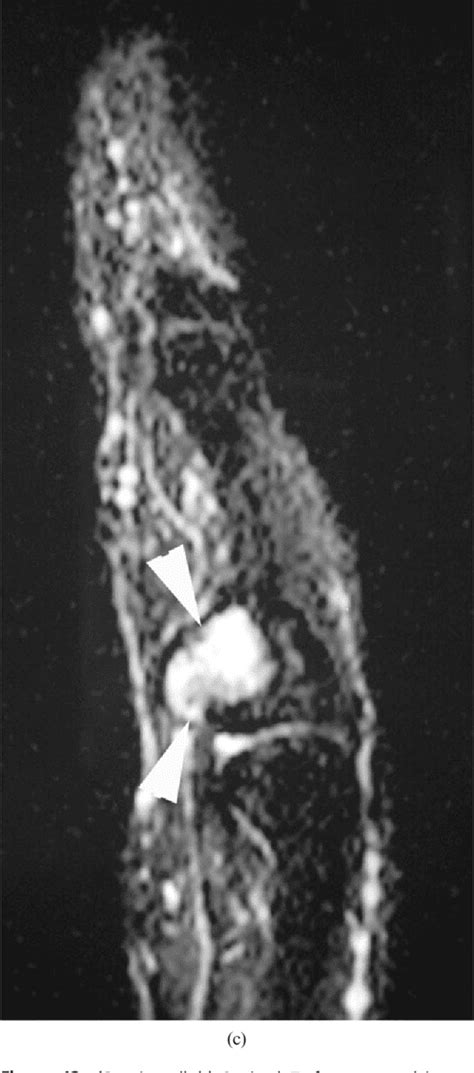 Figure 6 From Mri Of Soft Tissue Masses Of The Hand And Wrist