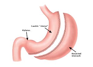 Gastric Sleeve in Los Angeles - Weight Loss Surgery Los Angeles | Dr. David Davtyan