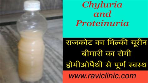 Chyluria Proteinuria And Weight Loss Case Cured By Homeopathy Youtube