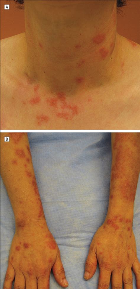 Subacute Cutaneous Lupus Erythematosus Associated With Capecitabine