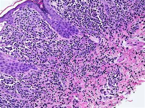Pathology Outlines Mastocytosis Of Skin