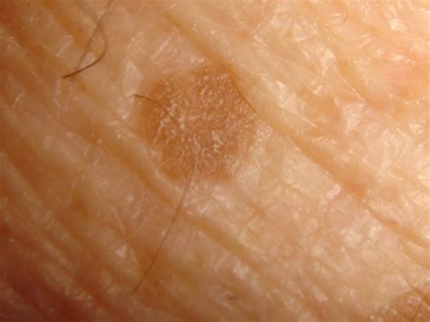 Actinic Keratosis Solar Keratosis Sun Spots