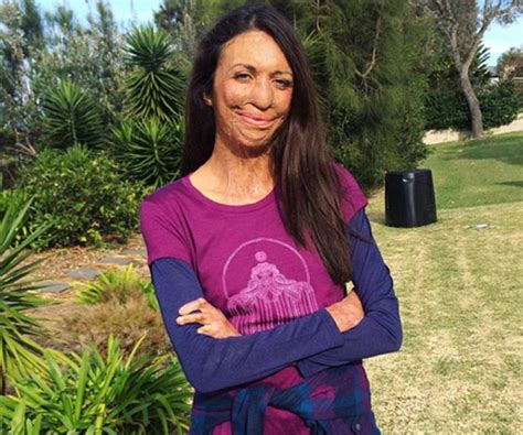 Brave Turia Pitt Reveals Surgery Struggle Australian Women S Weekly