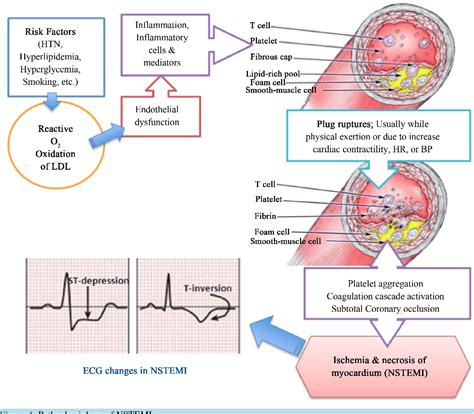 Nstemi Difference Between Nstemi And Stemi Acute Coronary Syndrome