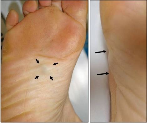 I have a quarter sized lump on the bottom of my foot, kinda between the second and third toes. The patient presented with a solitary subcutaneous tumo ...