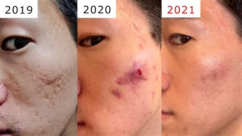 2021クレーター肌凹凸ニキビ跡 治療 ビフォーアフター1年間でどれほど改善したのか経過報告 acne scarring