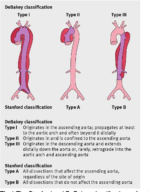 Aortic Dissection Pathophysiology