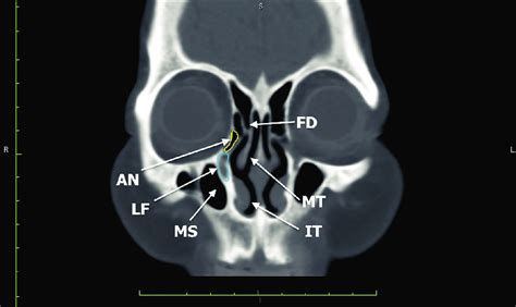 Coronal Computed Tomography Scan Showing The Relationship Of The