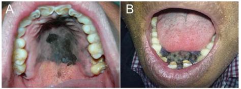 Melanoma Oral Mucosa