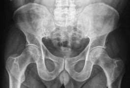 Osteoporosis Exercises For The Femoral Neck Livestrong Com Radiografia Miniaturas Salud De