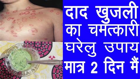 Home Remedies For Ringworm How To Cure Ringworm In 2 Days Youtube