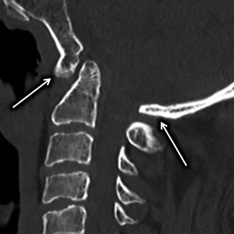 Sagittal Ct Of The Cervical Spine Demonstrating Congenital