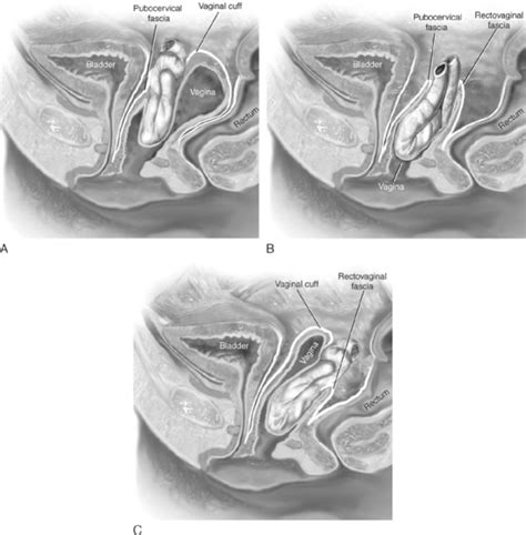 Surgical Treatment Of Vaginal Vault Prolapse And Enterocele Plastic Surgery Key