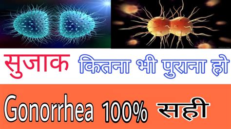 सुजाक रोग लिंग मे सूजन,पैशाब करते जलन, मवाद,खून आना | Gonorrhea
