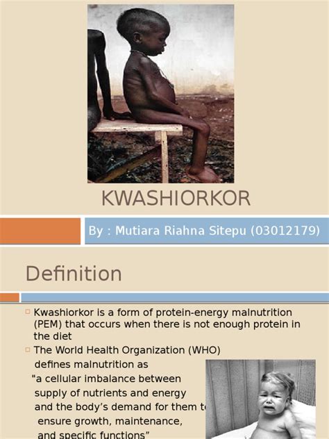 Kwashiorkor 2 Malnutrition Health Sciences