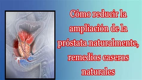 Cómo Reducir La Ampliación De La Próstata Naturalmente Remedios