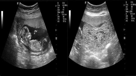 Ultrasound Image Showing Snowstorm Pattern Of Complete Hydatidiform