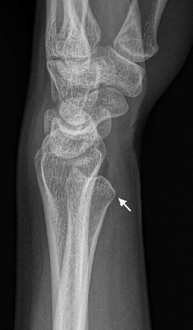 Left Wrist Radiograph Lateral View Showing Volar