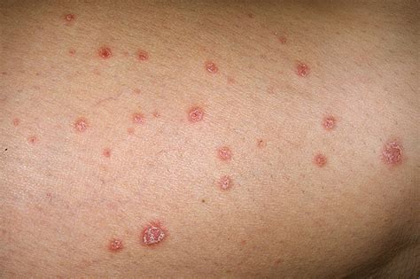 Home Remedies And Diet In Psoriasis Natural Remedies For Psoriasis