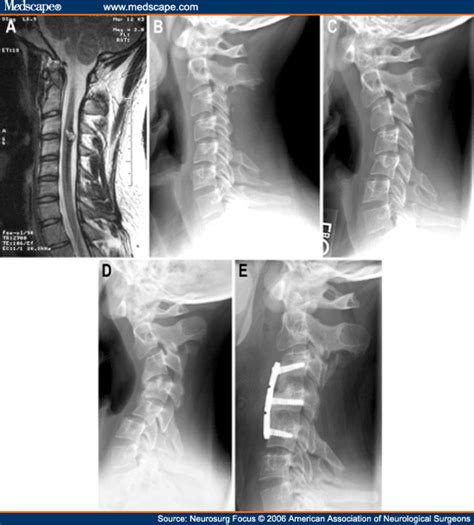 Cervical Spine Deformity And Resection Of Spinal Cord Tumors