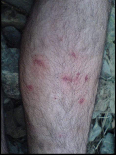 The Lesions On The Lower Leg Note The Erythema Around The Biting Sites