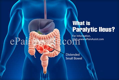 What Is Paralytic Ileus And How Is It Treatedcauses Symptoms