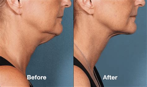 Kybella Injectable Chin Fat Reduction Barrington Il Med Spa Non Surgical