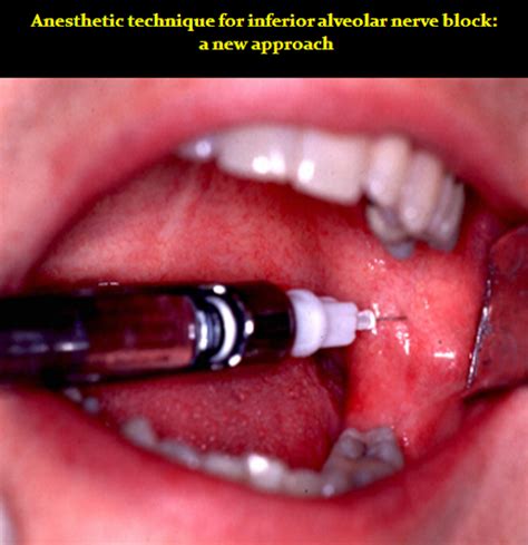Pdf Anesthetic Technique For Inferior Alveolar Nerve Block A New